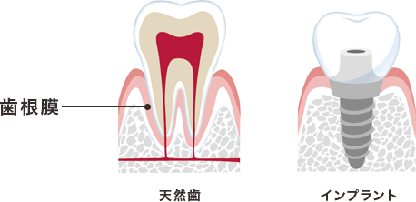 天然歯とインプラント