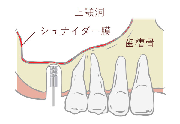 ドリルで歯槽骨に穴を開ける