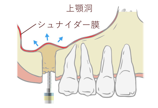 インプラントを埋入するスペースを作る