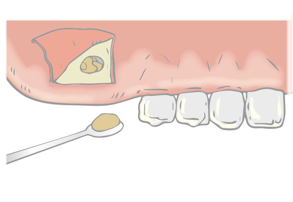 歯槽骨を露出し、小さな穴を開ける
