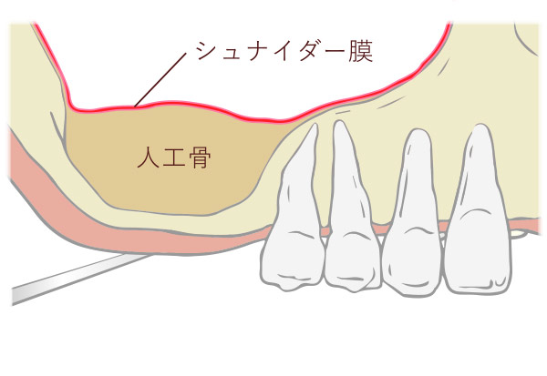 人工骨が、自分の骨に変わるのを待つ