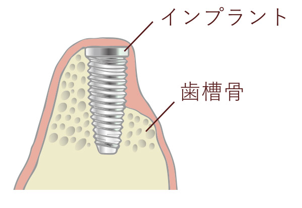 インプラントの一部が露出