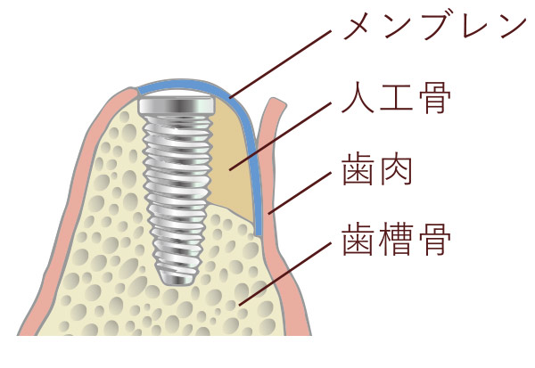 歯肉を戻して骨の再生を待つ