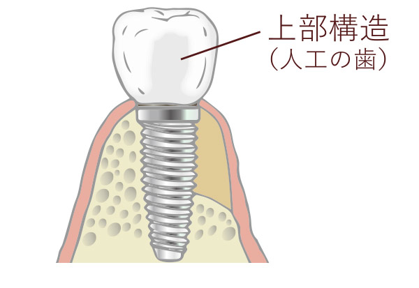 人工歯を装着