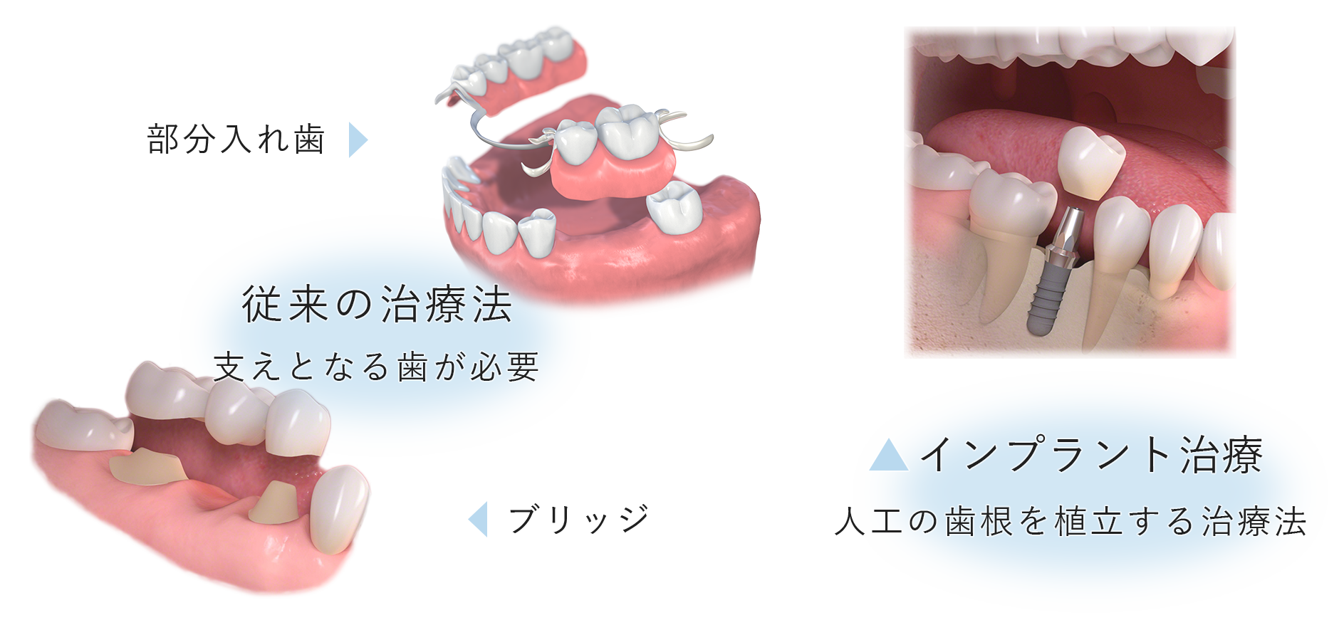 インプラント治療とその他の治療法