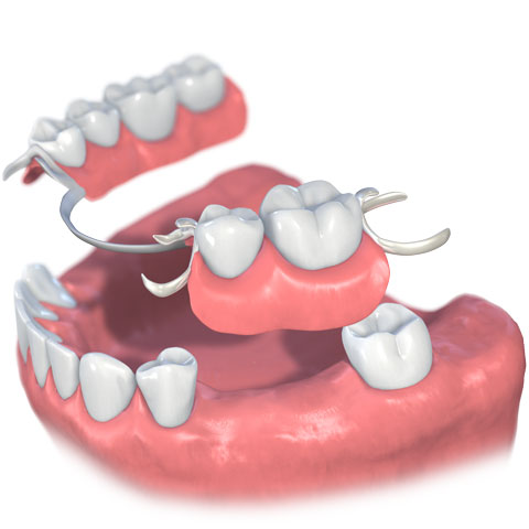 部分入れ歯