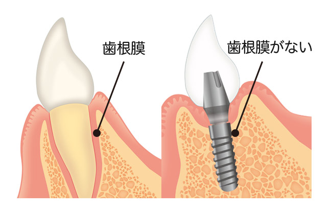 インプラントと歯根膜