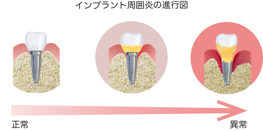 歯科 インプラント トラブル 急増 の 理由