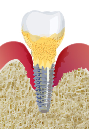 インプラント周囲炎