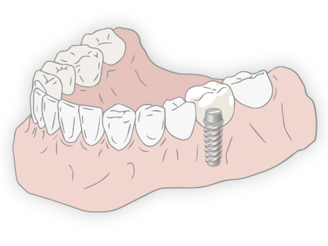 インプラント
