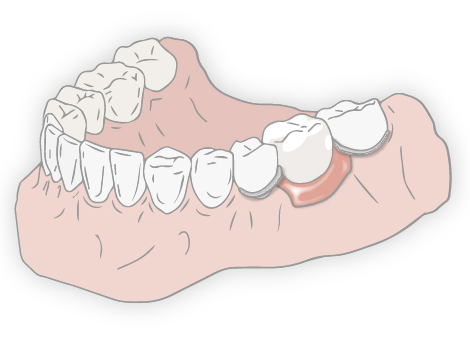部分入れ歯